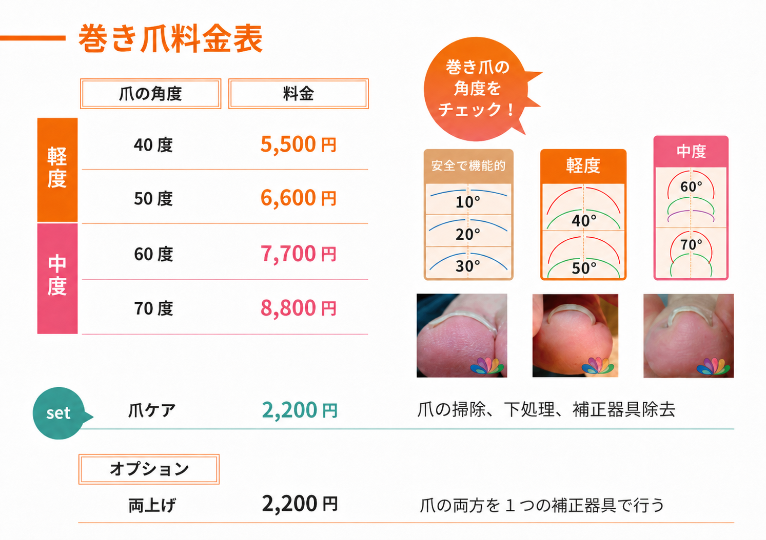 巻き爪料金表